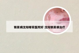 银屑病沈阳哪家医院好 沈阳银屑病治疗