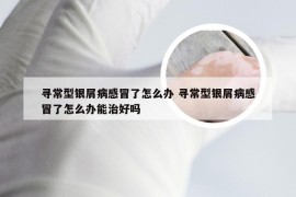 寻常型银屑病感冒了怎么办 寻常型银屑病感冒了怎么办能治好吗