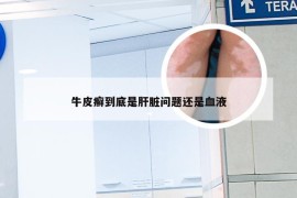 牛皮癣到底是肝脏问题还是血液