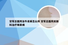 空军总医院治牛皮癣怎么样 空军总医院皮肤科治疗银屑病