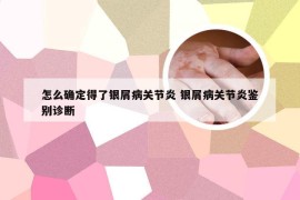怎么确定得了银屑病关节炎 银屑病关节炎鉴别诊断