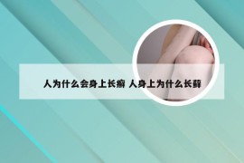 人为什么会身上长癣 人身上为什么长藓