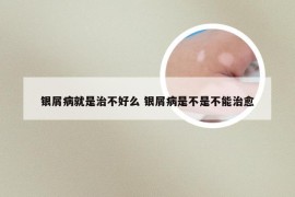 银屑病就是治不好么 银屑病是不是不能治愈