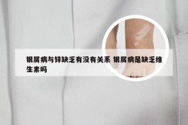 银屑病与锌缺乏有没有关系 银屑病是缺乏维生素吗