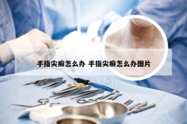 手指尖癣怎么办 手指尖癣怎么办图片