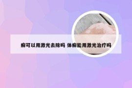 癣可以用激光去除吗 体癣能用激光治疗吗