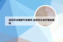 运动可以缓解牛皮癣吗 运动可以治疗银屑病吗