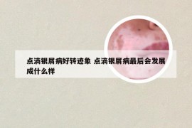 点滴银屑病好转迹象 点滴银屑病最后会发展成什么样