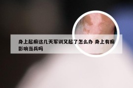 身上起癣这几天军训又起了怎么办 身上有癣影响当兵吗