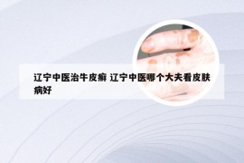 辽宁中医治牛皮癣 辽宁中医哪个大夫看皮肤病好