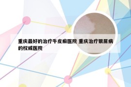 重庆最好的治疗牛皮癣医院 重庆治疗银屑病的权威医院