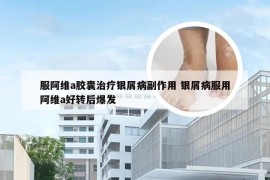 服阿维a胶囊治疗银屑病副作用 银屑病服用阿维a好转后爆发