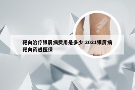 靶向治疗银屑病费用是多少 2021银屑病靶向药进医保
