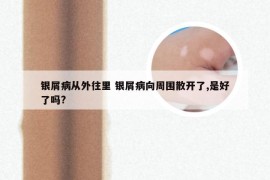 银屑病从外往里 银屑病向周围散开了,是好了吗?