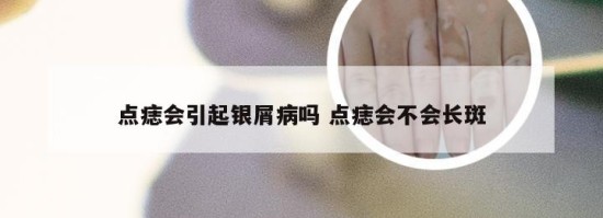 点痣会引起银屑病吗 点痣会不会长斑