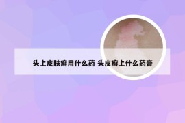 头上皮肤癣用什么药 头皮癣上什么药膏