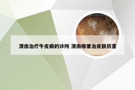 渭南治疗牛皮癣的诊所 渭南哪里治皮肤厉害