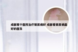 成都那个医院治疗银屑病好 成都看银屑病最好的医生