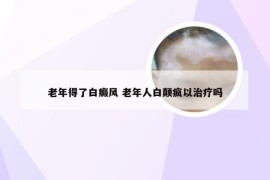老年得了白癜风 老年人白颠疯以治疗吗