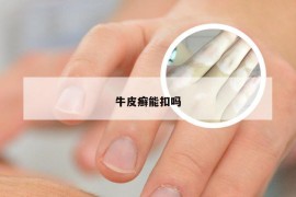 牛皮癣能扣吗