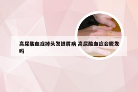 高尿酸血症掉头发银屑病 高尿酸血症会脱发吗