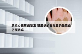 总担心银屑病复发 银屑病的复发真的是靠自己预防吗