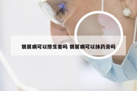 银屑病可以擦生姜吗 银屑病可以抹药膏吗