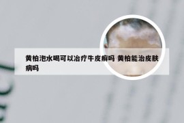 黄柏泡水喝可以冶疗牛皮癣吗 黄柏能治皮肤病吗