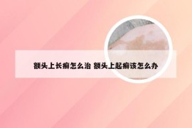 额头上长癣怎么治 额头上起癣该怎么办