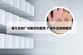 看牛皮癣广州最好的医院 广州牛皮肤癣医院