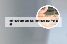 哈尔滨看银屑病那家好 哈尔滨哪里治疗银屑病