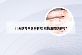 什么肽对牛皮癣有效 肽能治皮肤病吗?