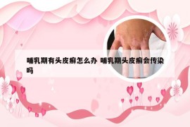 哺乳期有头皮癣怎么办 哺乳期头皮癣会传染吗