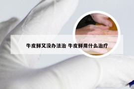 牛皮鲜又没办法治 牛皮鲜用什么治疗