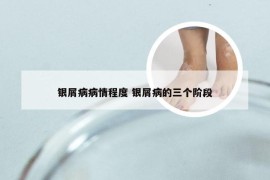 银屑病病情程度 银屑病的三个阶段
