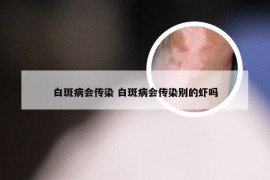 白斑病会传染 白斑病会传染别的虾吗