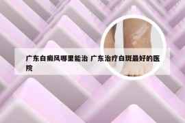 广东白癜风哪里能治 广东治疗白斑最好的医院