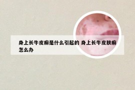 身上长牛皮癣是什么引起的 身上长牛皮肤癣怎么办