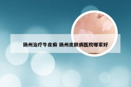 扬州治疗牛皮癣 扬州皮肤病医院哪家好