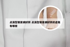 点滴型银屑病好转 点滴型银屑病好转的迹象有哪些