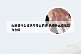 头癣是什么症状用什么药好 头癣什么症状能自愈吗