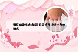 银屑病能喝sle结婚 银屑病可以喝一点啤酒吗