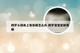 四岁小孩身上有皮癣怎么办 四岁宝宝皮肤有癣