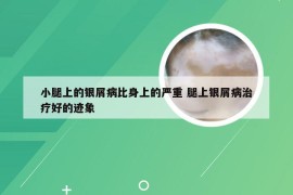 小腿上的银屑病比身上的严重 腿上银屑病治疗好的迹象