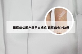 银屑病贫困户属于大病吗 银屑病有补助吗