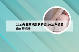 2023年银屑病最新研究 2021年银屑病有望根治
