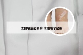 太阳晒后起的癣 太阳晒了起癣