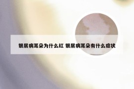 银屑病耳朵为什么红 银屑病耳朵有什么症状