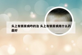 头上有银屑病咋的治 头上有银屑病用什么药最好