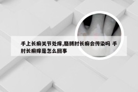 手上长癣关节处痒,胳膊肘长癣会传染吗 手肘长癣痒是怎么回事